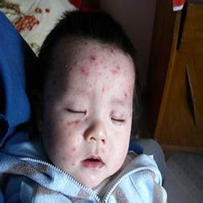 水痘的症状是什么