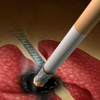 肺癌的最佳治疗方法有哪些