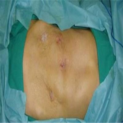 直肠癌83岁还能做手术吗