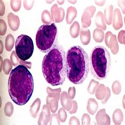 急性髓性白血病怎么治疗