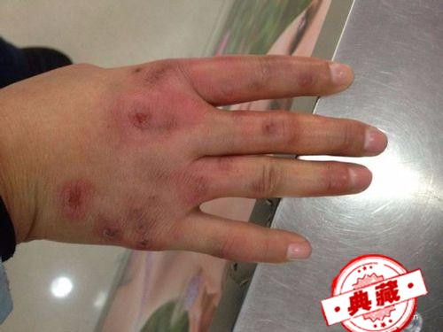 长冻疮了怎么治疗和预防？