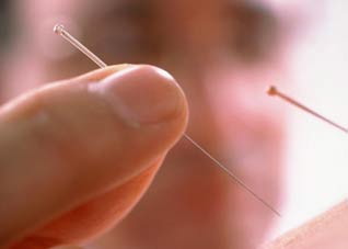 针灸减肥不当易致病 如何针灸才最靠谱