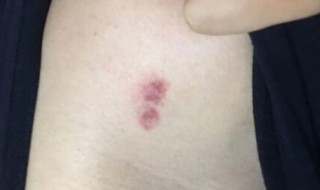 刚种的吻痕热敷还是冷敷（新吻痕热敷还是冷敷）
