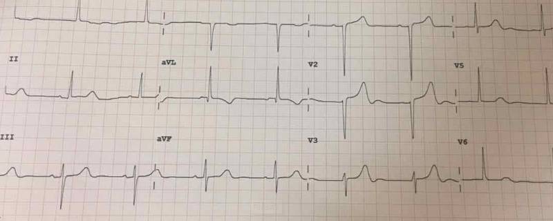 t波改变是什么意思？ 下壁t波改变是什么意思