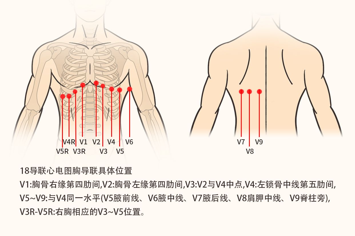 18导心电图连接示意图（十八导心电图连接）