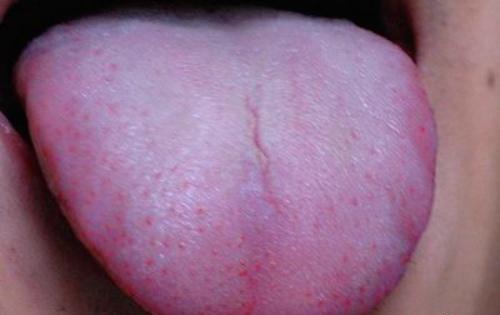 艾滋病初期舌头症状（艾滋病初期舌头症状图片）
