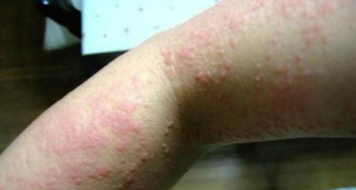 过敏性荨麻疹 过敏性荨麻疹的症状和治疗