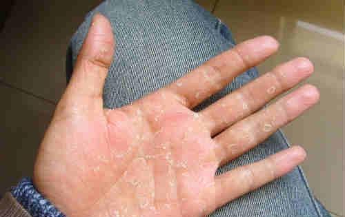 季节性手脱皮 季节性手脱皮最快恢复的方法