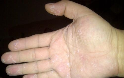 手掌脱皮是什么原因 手掌脱皮是什么原因?怎么治疗?