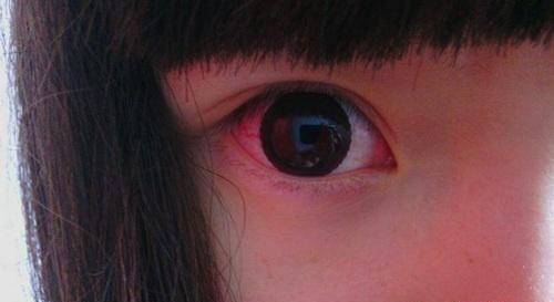 红眼的偏方