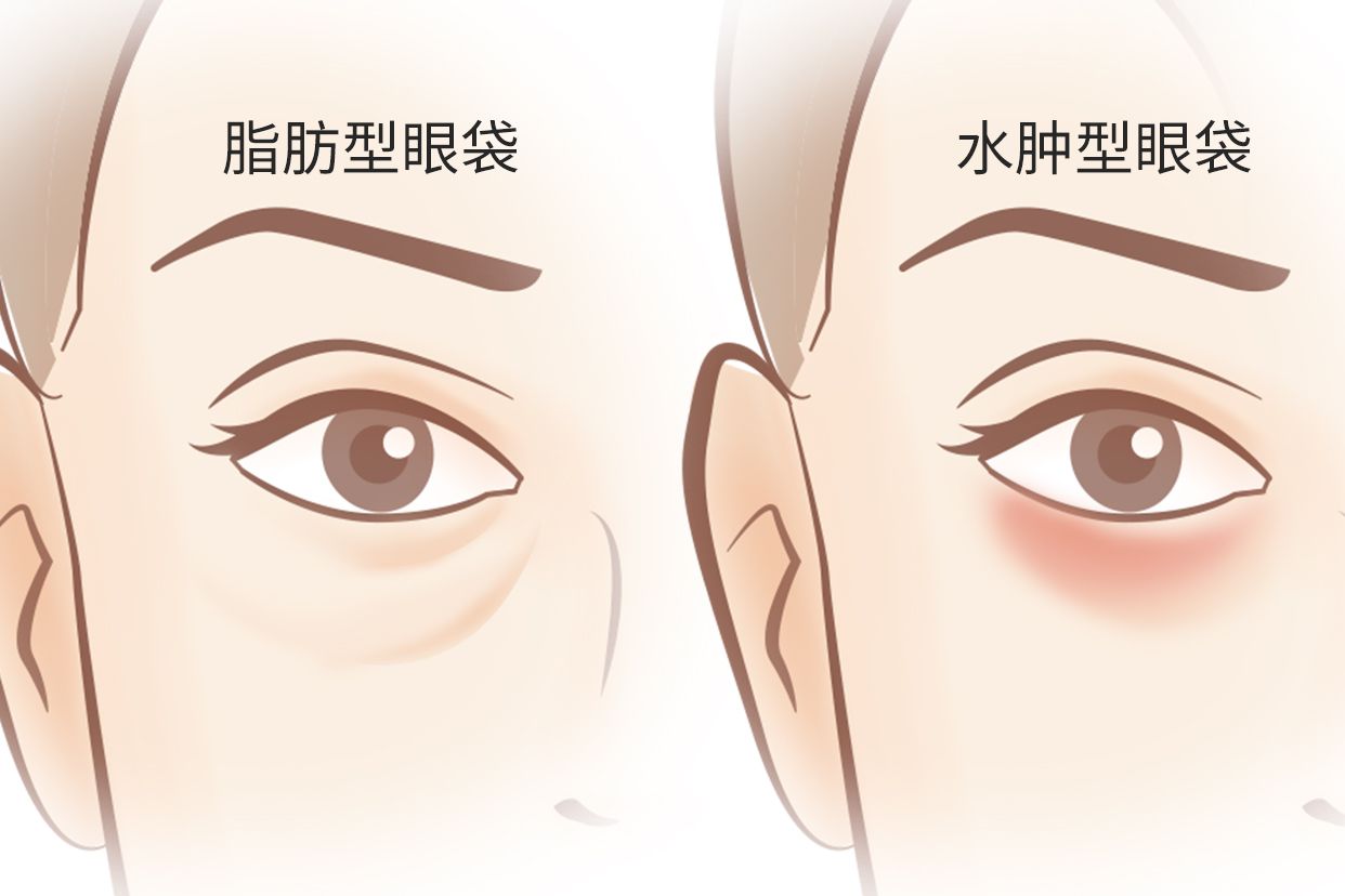 脂肪型眼袋和水肿型眼袋区别图 脂肪型眼袋和水肿型眼袋区别图片对比