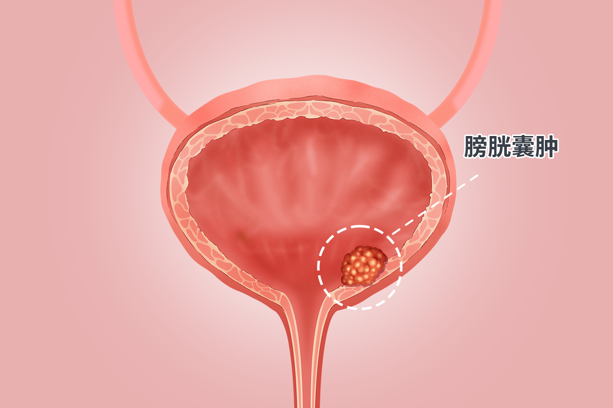 膀胱囊肿图片（膀胱囊肿图片真实）