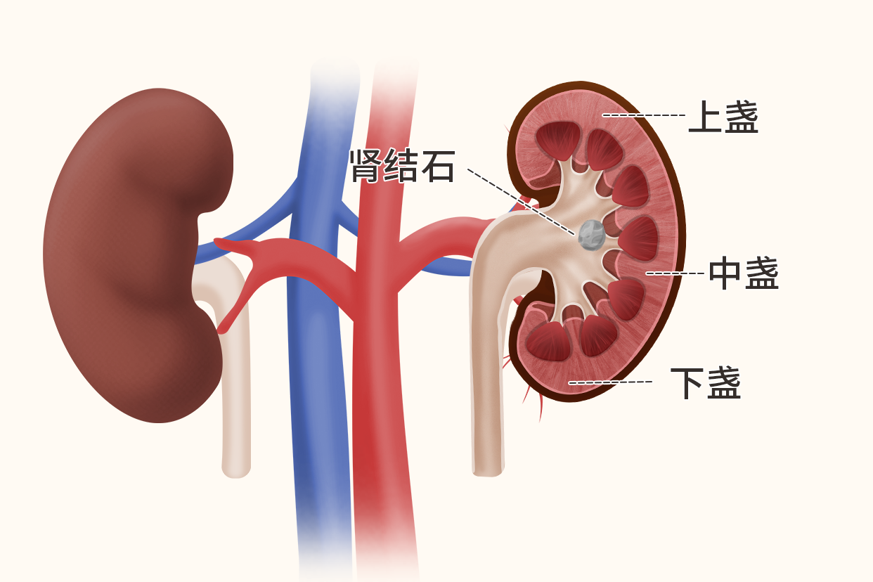 肾中盏结石图片（肾盏结石图片位置示意图）