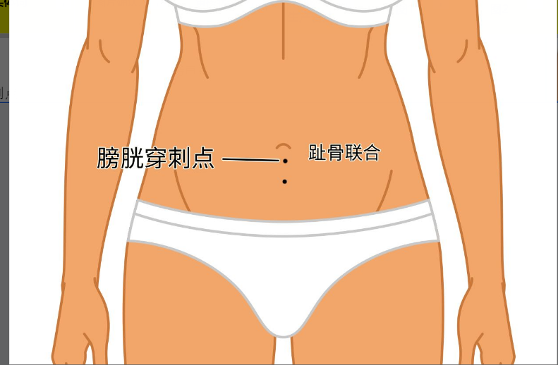 膀胱穿刺点的位置图片（膀胱穿刺部位在哪）