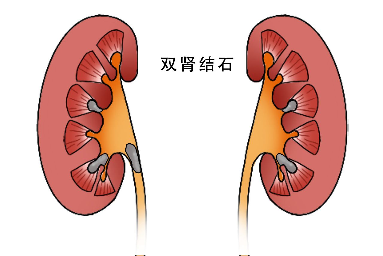 双肾结石图片（双肾结石图片0.2cm清晰图片）