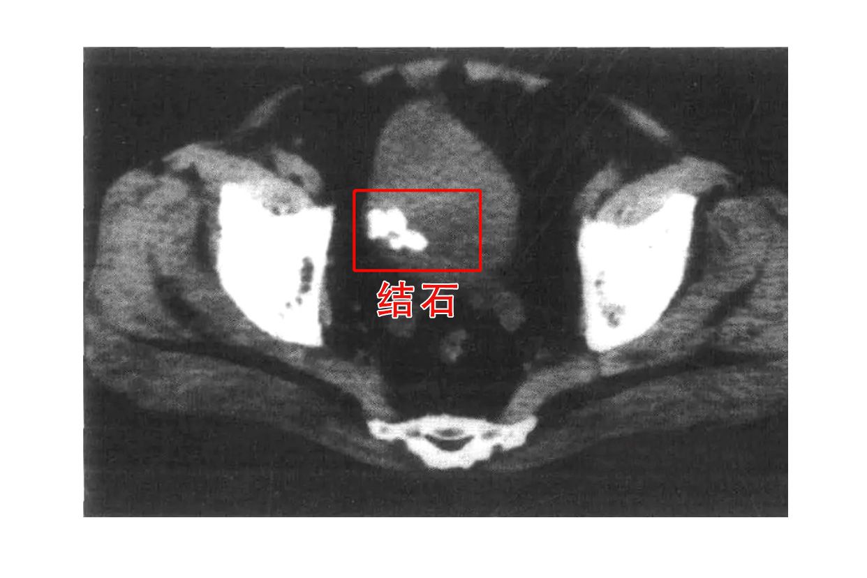 膀胱结石ct图片 膀胱结石拍片图片