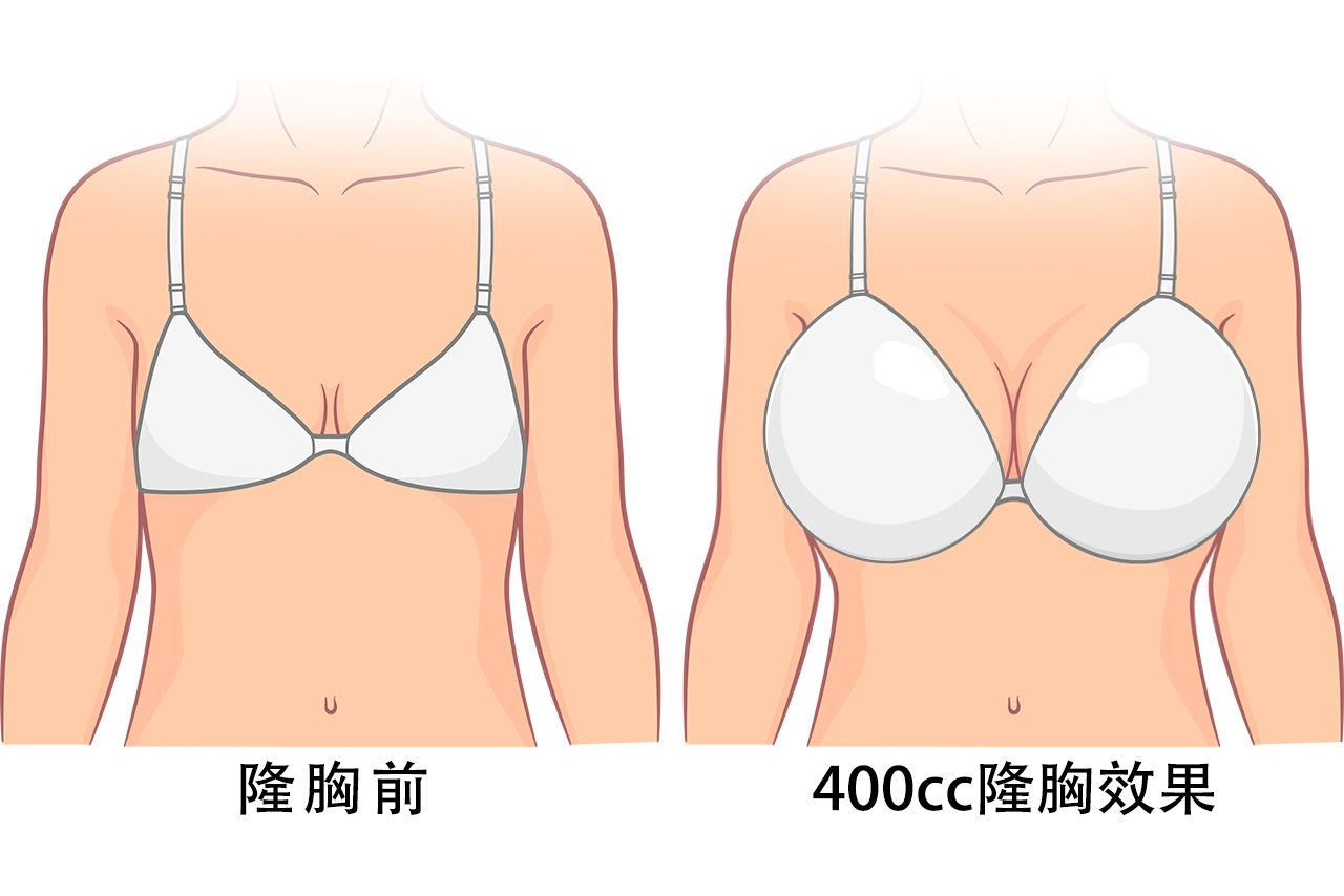 假体隆胸400cc真人图片（假体隆胸400cc真人图片大全）