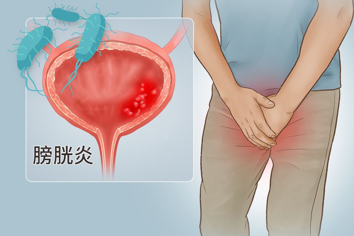 男性膀胱炎图片 男性膀胱炎图片及症状