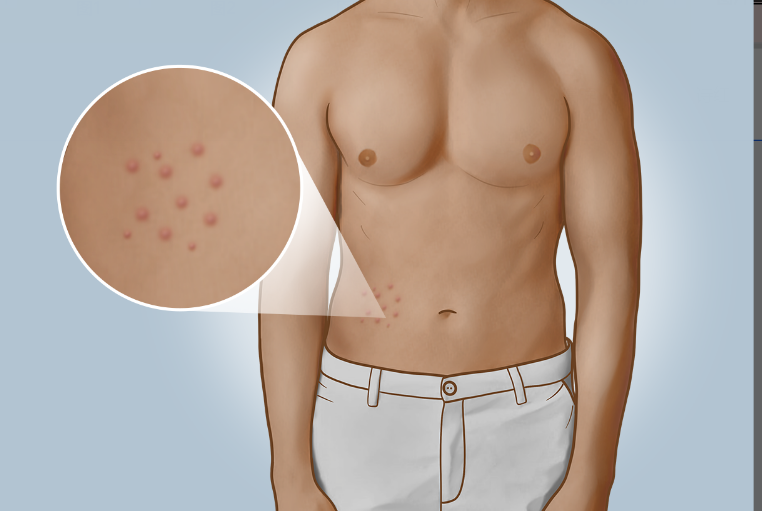 肚子上长红色的痘痘是怎么回事图片 肚子上长红色的痘痘是怎么回事图片男