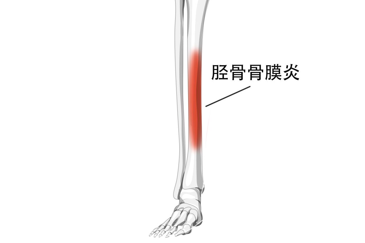 小腿胫骨骨膜炎图片 小腿胫骨骨膜炎图片高清