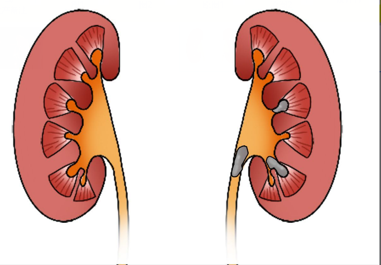 左肾结石图片 左肾结石图片女性