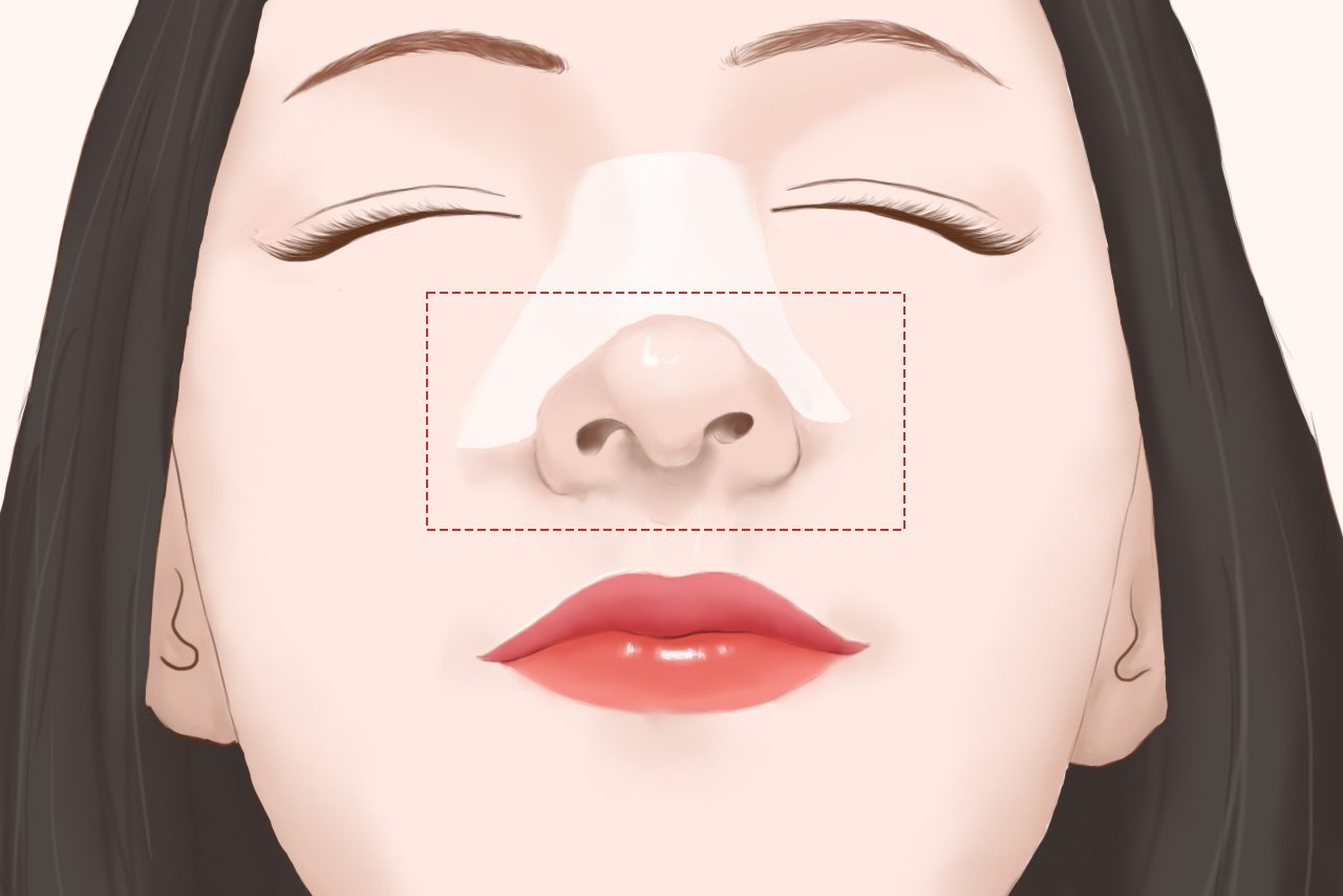 隆鼻后疤痕增生图片 隆鼻 疤痕增生