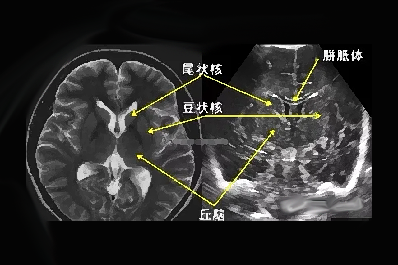 胎儿颅内结构正常超声图谱 胎儿颅内结构正常超声图谱图片