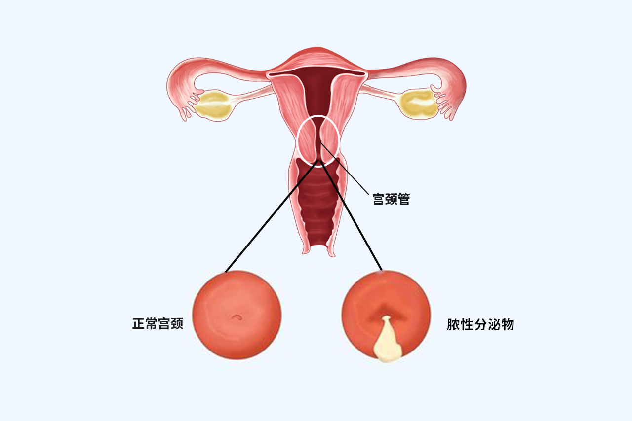 宫颈管内膜炎图片