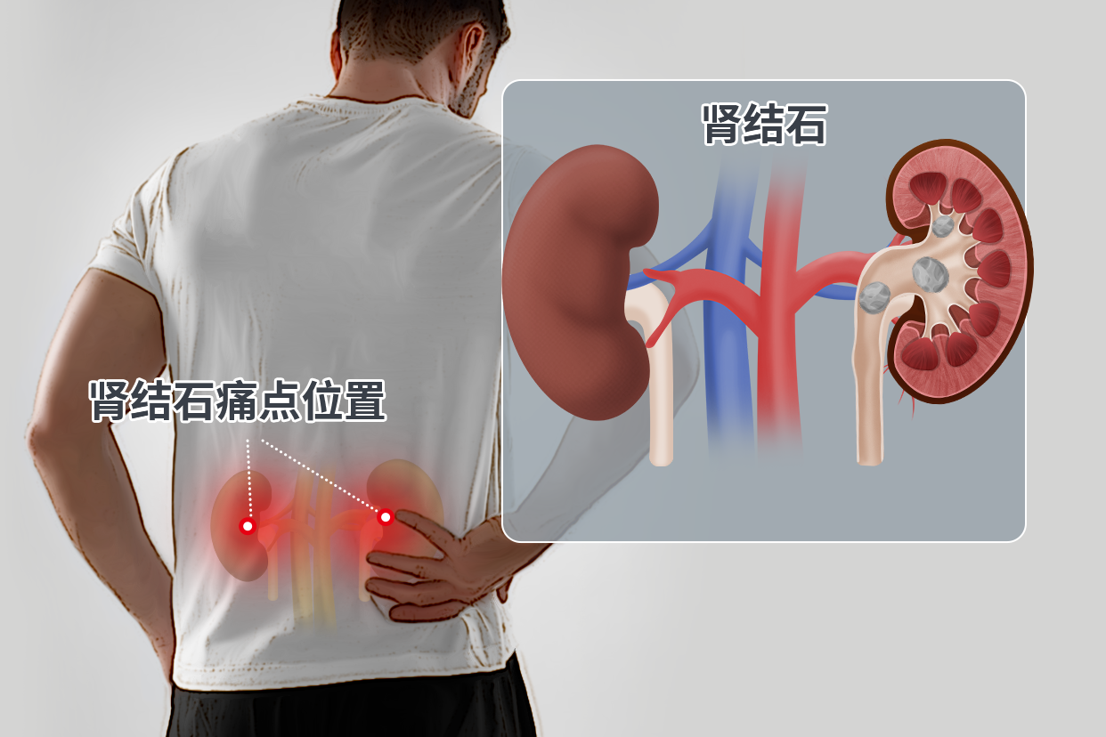 男人肾结石痛点的位置图