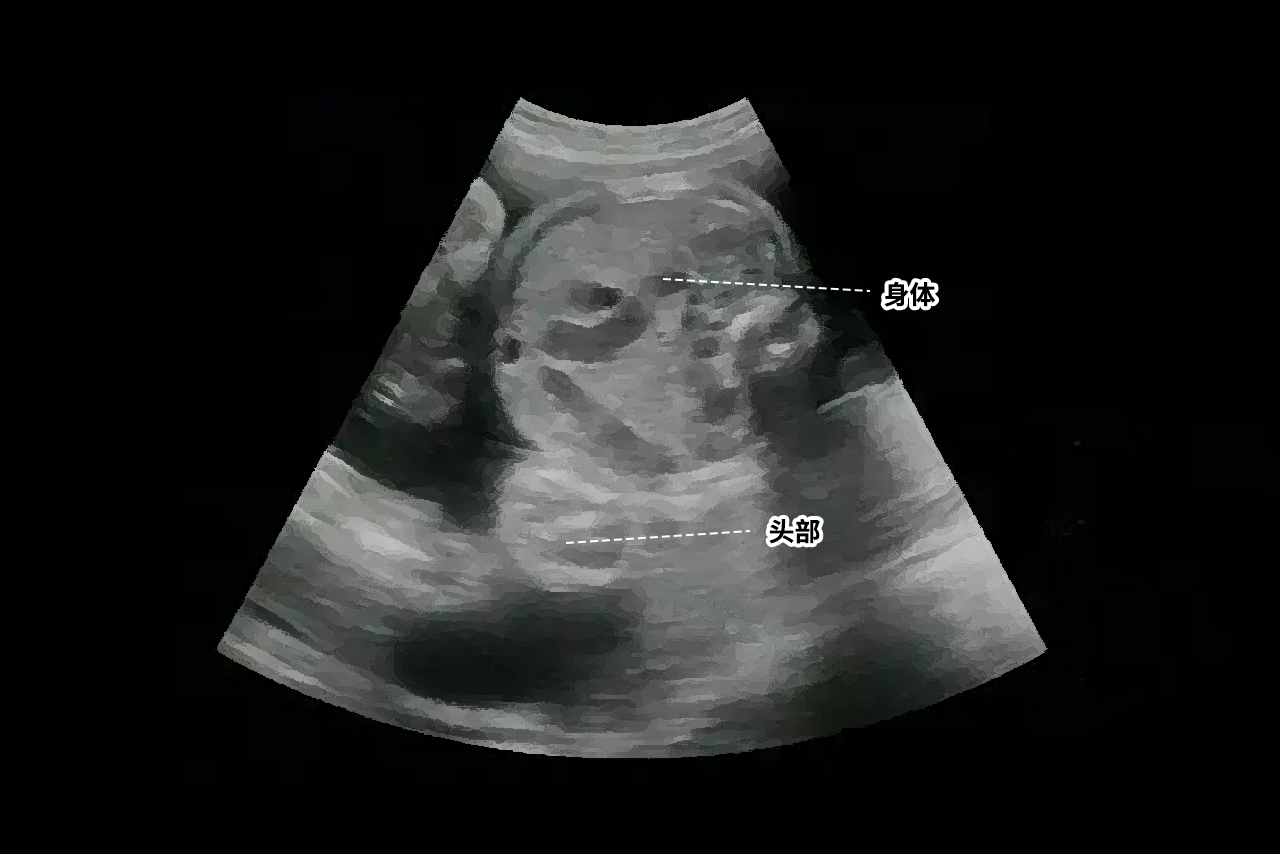 b超胎儿倒立着的图片