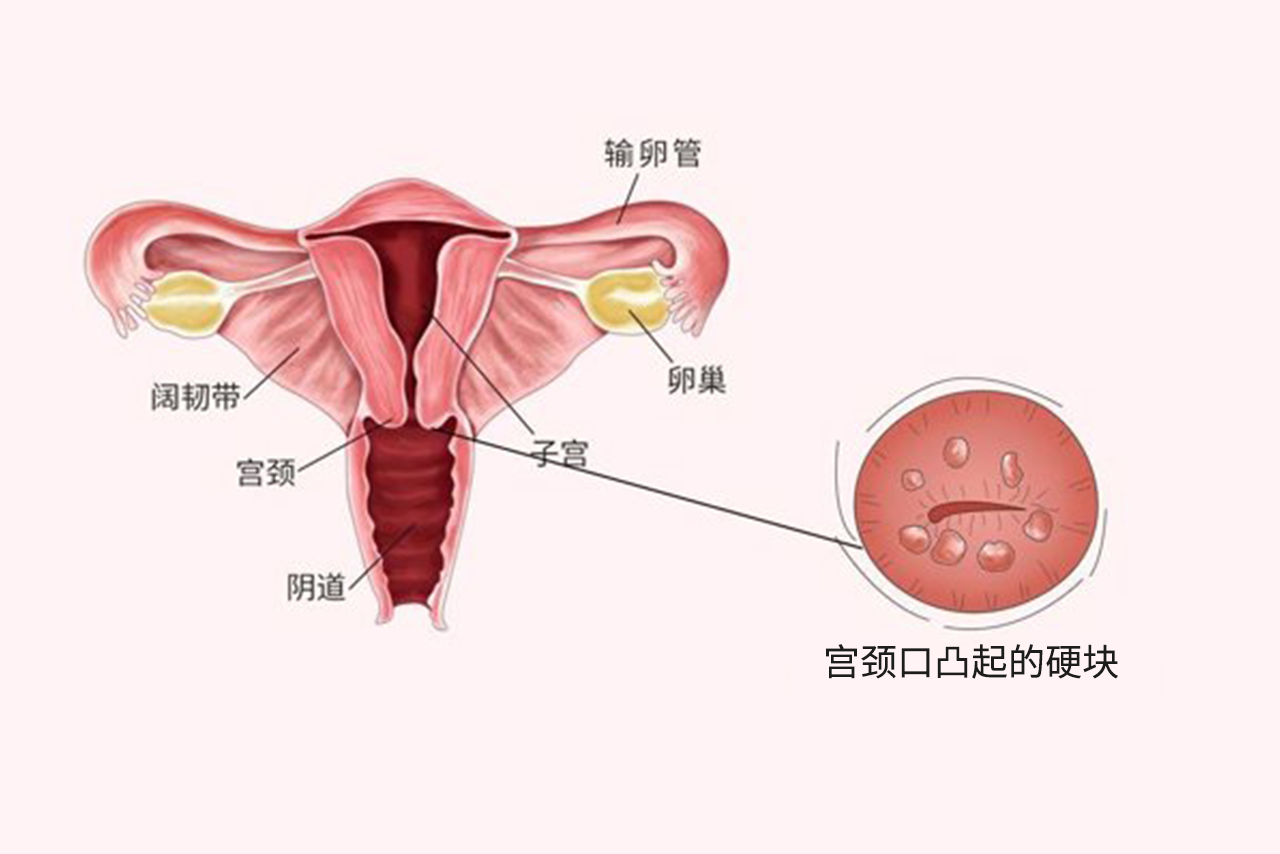 宫颈口摸到凸起硬块不痛不痒图片