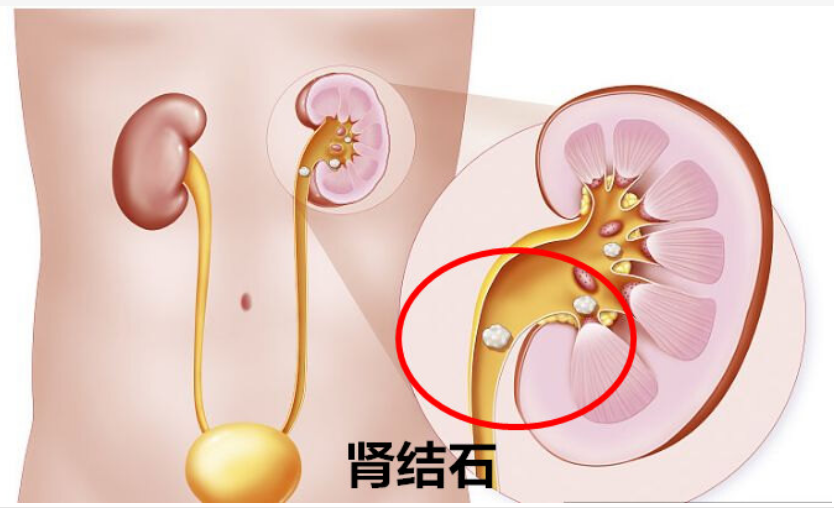 肾结节图片