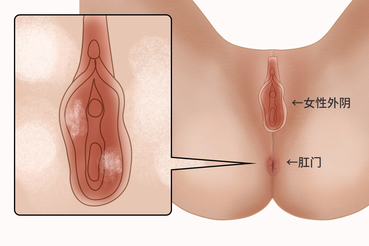 外阴鳞状图片