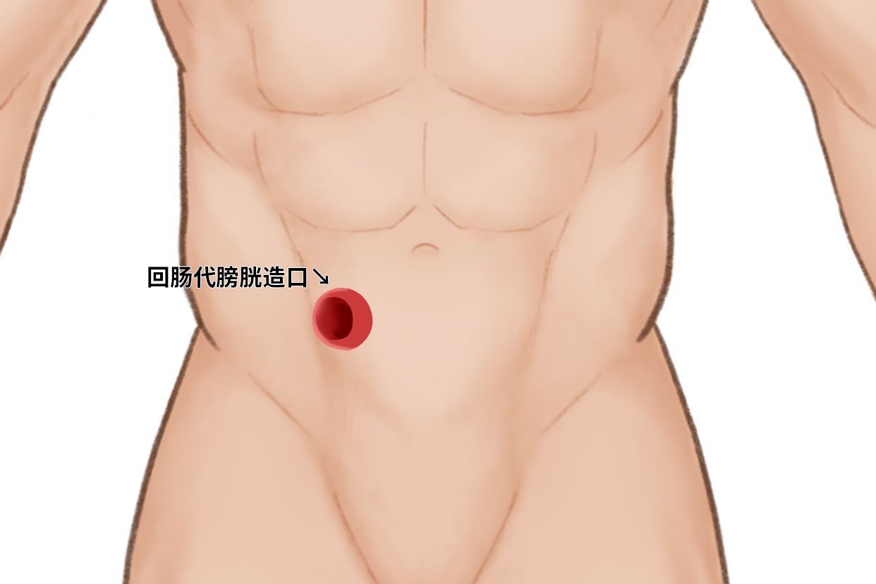 回肠代膀胱造口图片（回肠代膀胱术造口的护理）