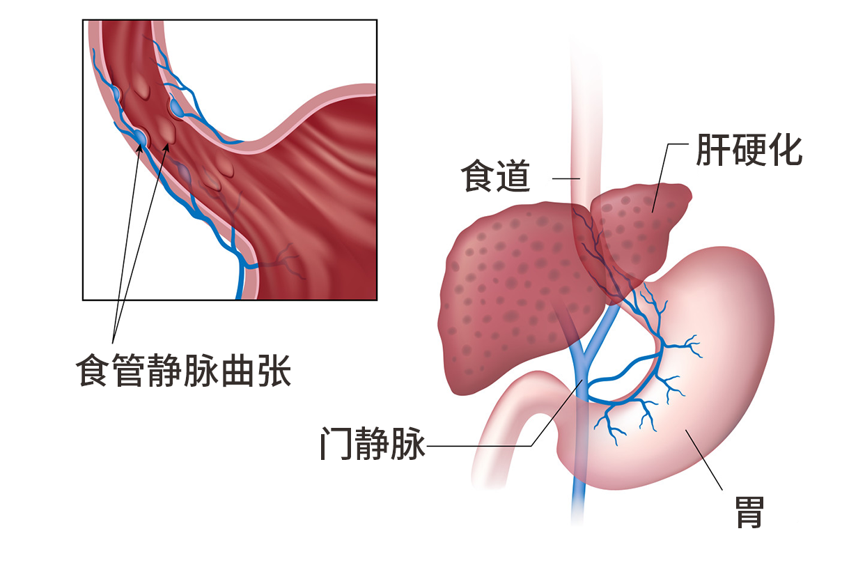 食管静脉曲张套扎器图解 食管静脉曲张套扎器图解图片