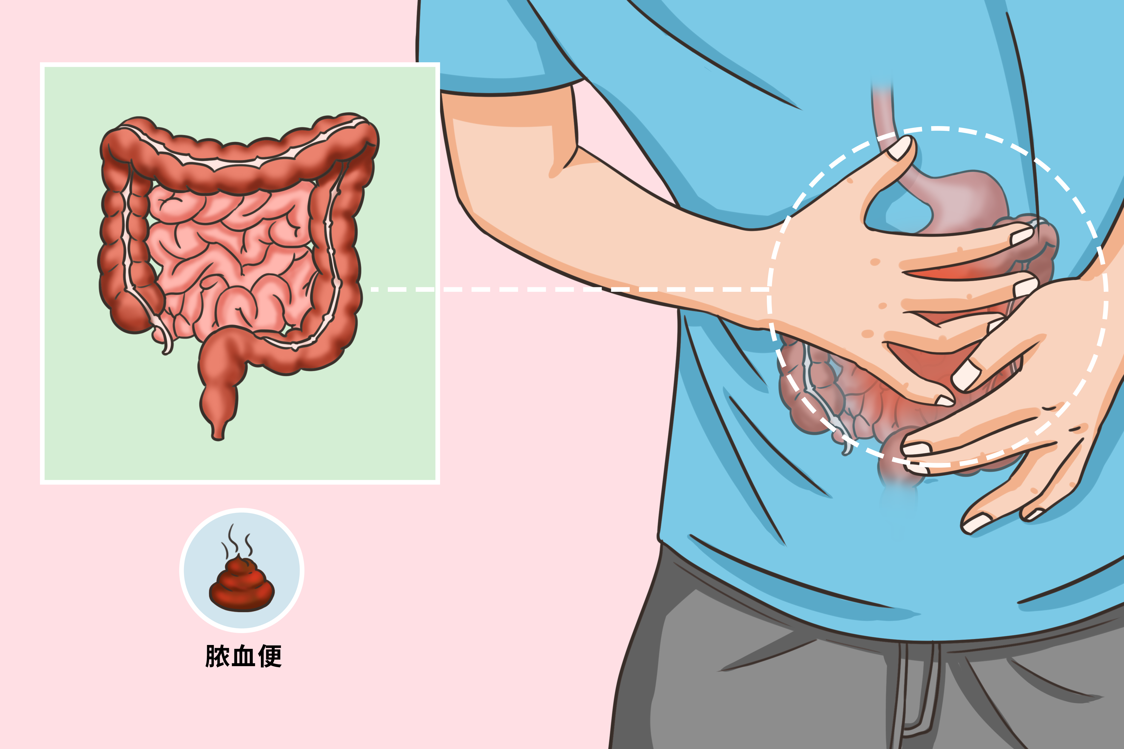 溃疡性结肠炎脓血便图片 溃疡性结肠炎大便带脓血