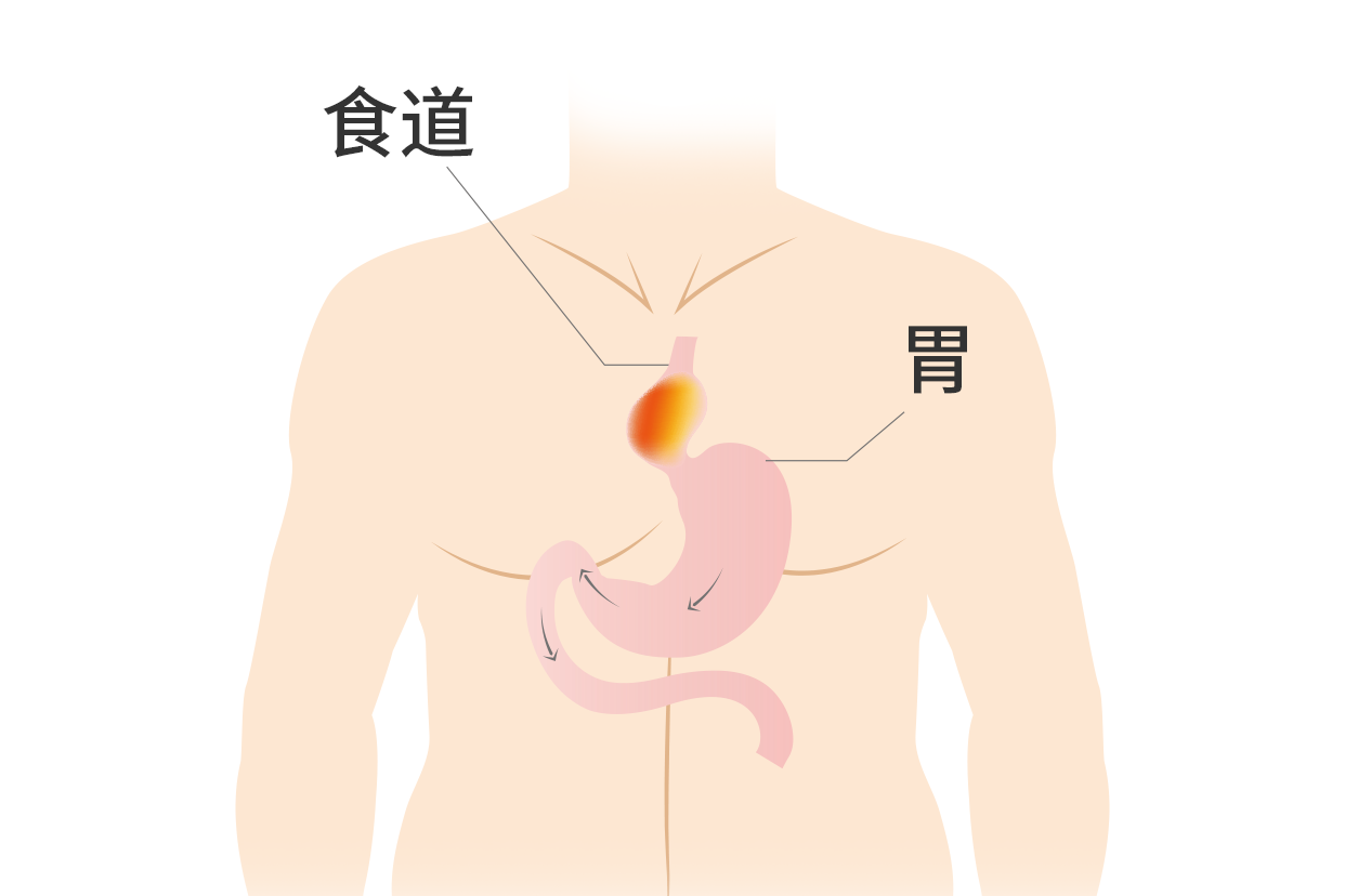 食管裂孔疝疼痛部位图 食管裂孔疝的位置