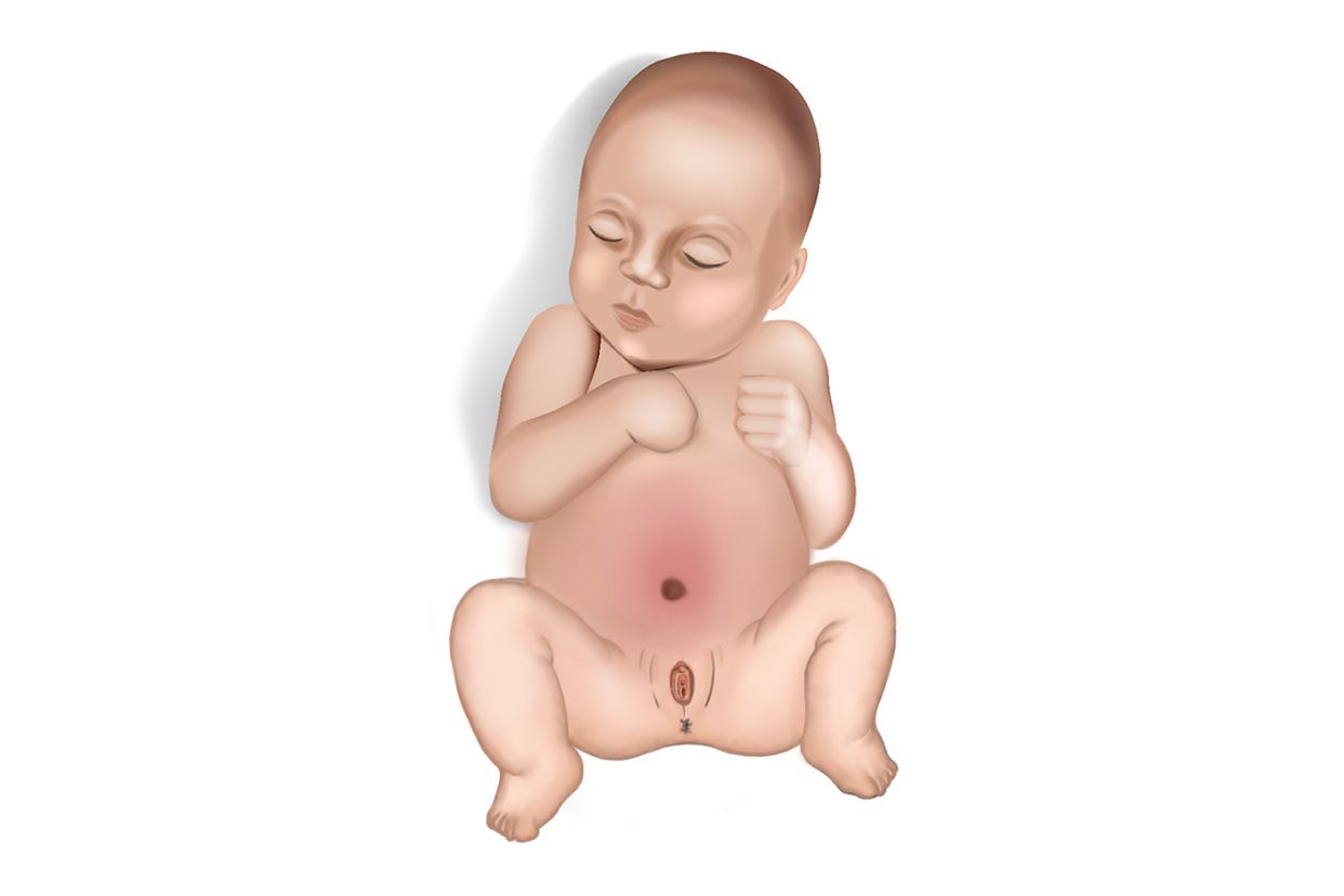 女宝宝小腹三角区鼓鼓的囊肿图片（婴儿小腹下面三角区有肿块）