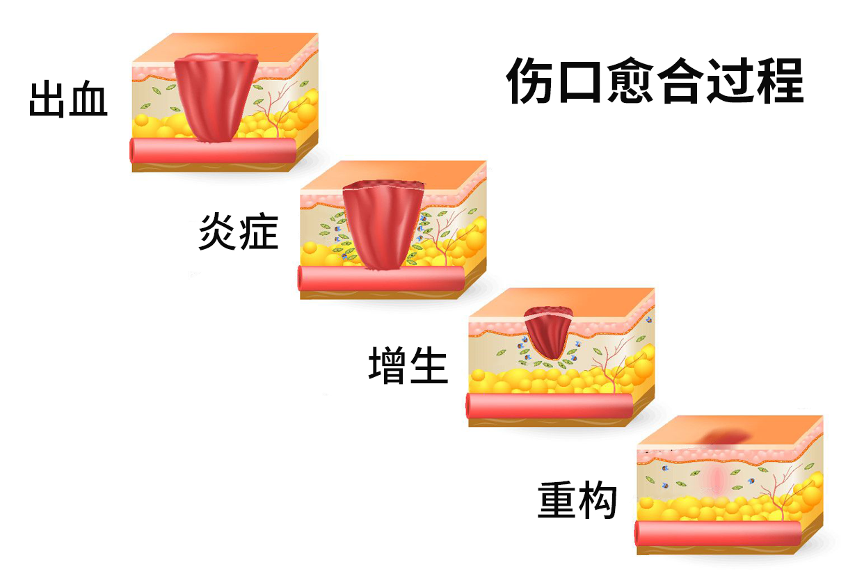 伤口愈合扇形图 伤口愈合过程图解