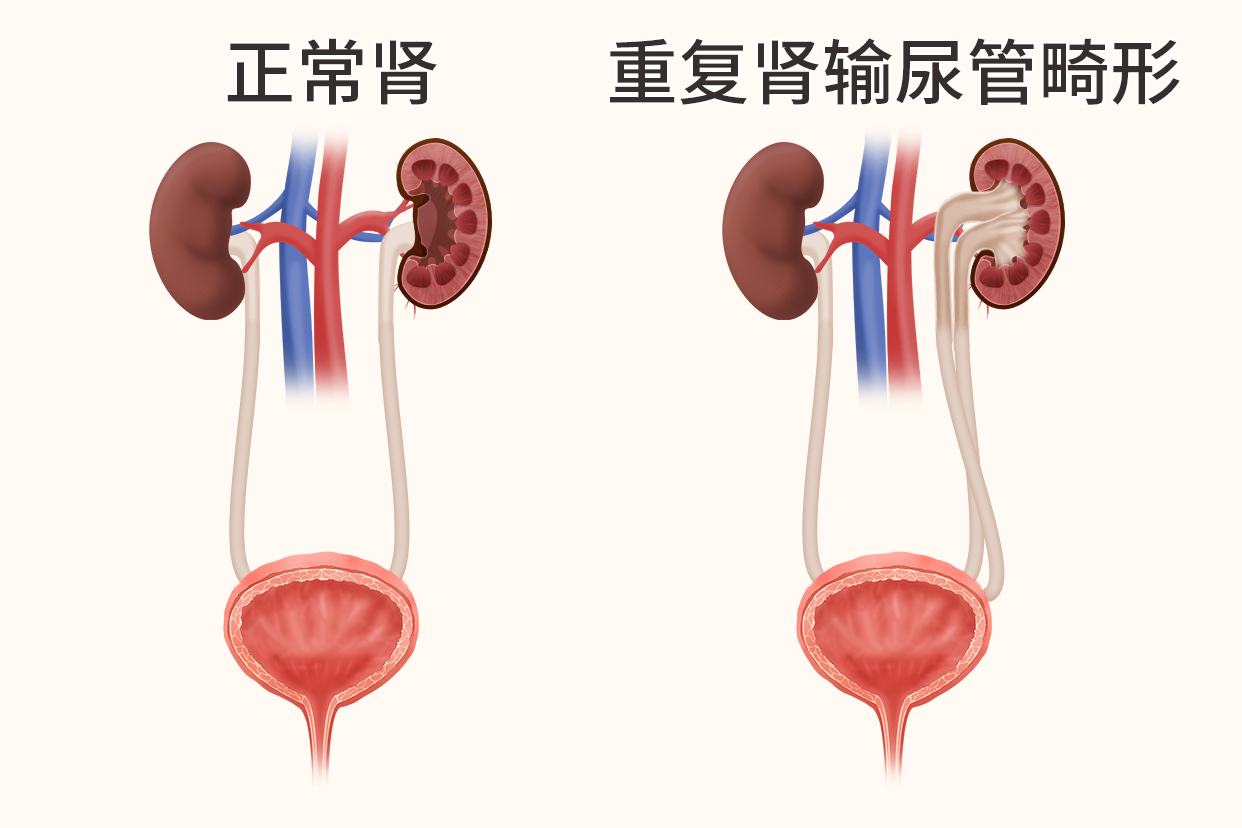 双肾双输尿管图片 双肾输尿管解剖图
