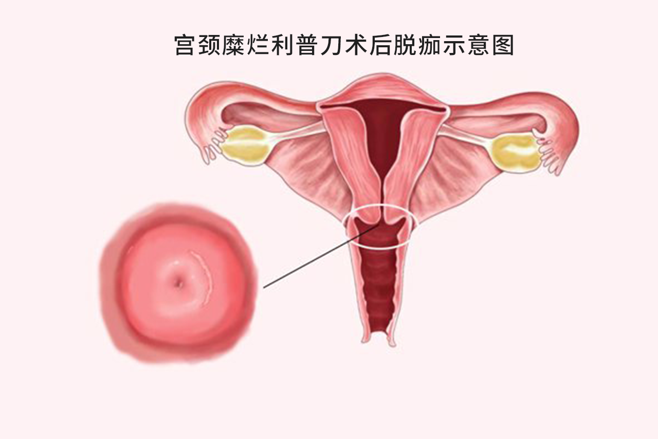 宫颈糜烂利普刀术后脱痂图片（宫颈糜烂利普刀术后脱痂图片）