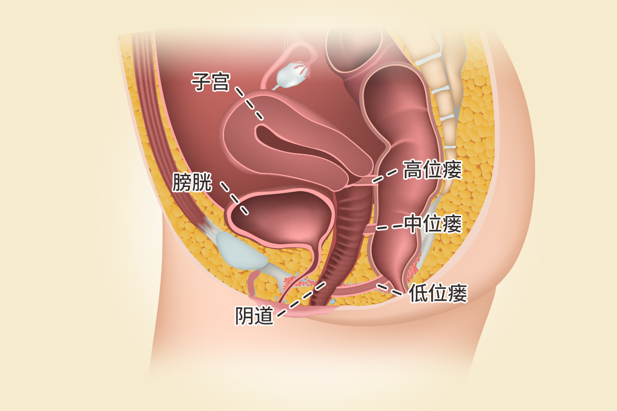 阴道瘘图片（内外瘘的图片）