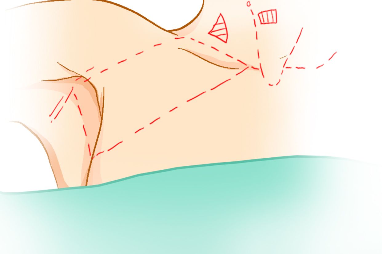 腋窝入路手术体位图（腋窝入路手术体位图）