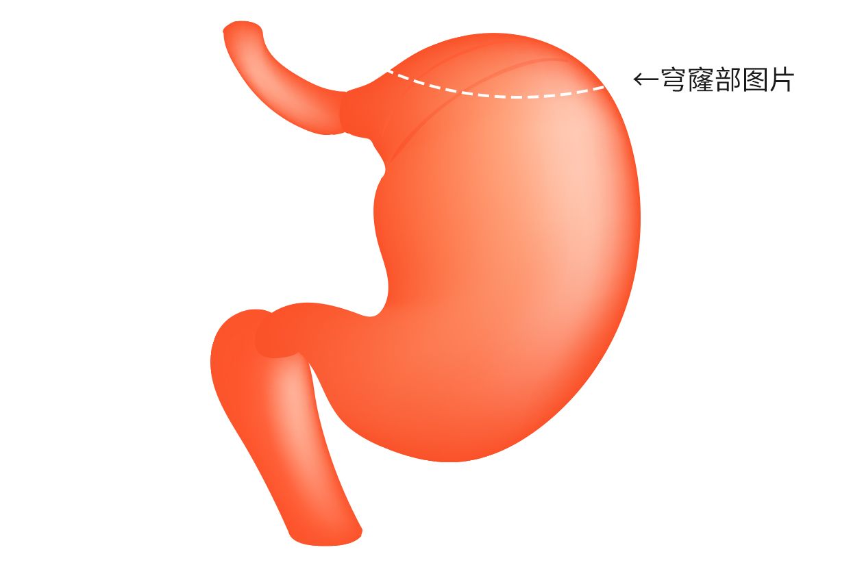 胃底穹窿部图片 胃底穹窿部在胃什么位置