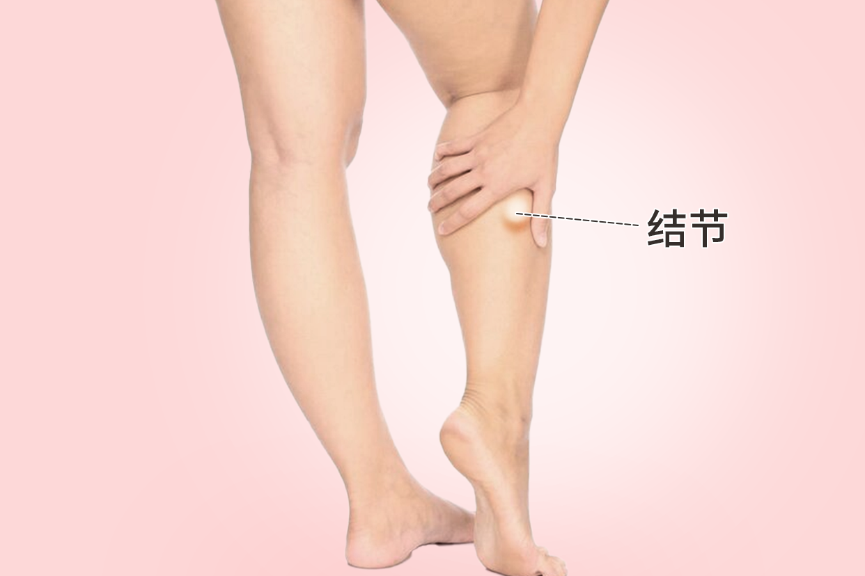 女人右小腿外侧结节图片 女性右腿小腿有结节