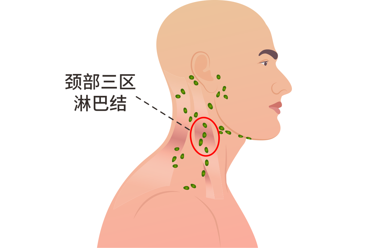 颈部三区淋巴结位置图 颈部二三区淋巴结在哪个位置