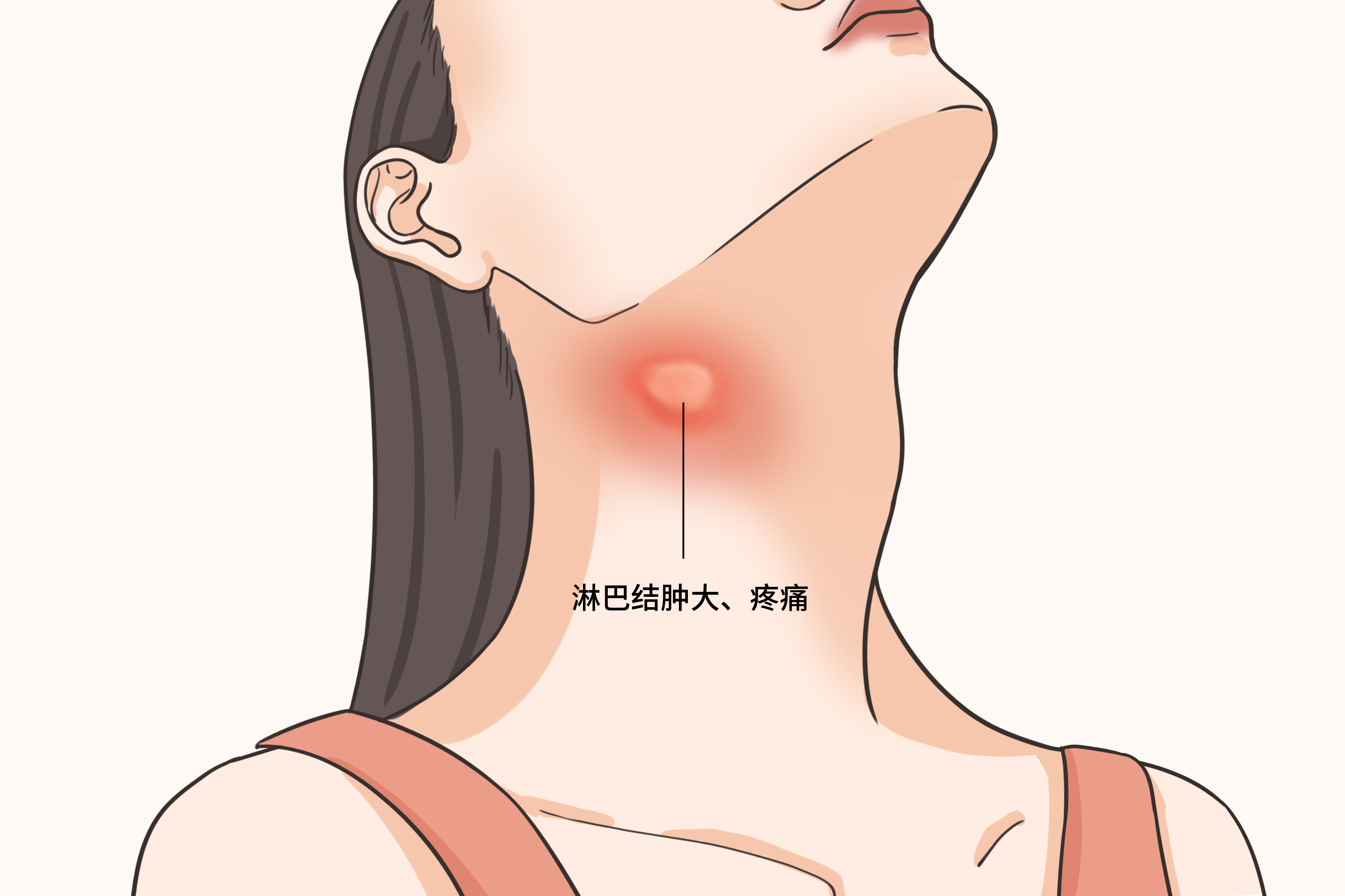 淋巴结肿大是什么颜色图片 淋巴结到底是什么颜色的