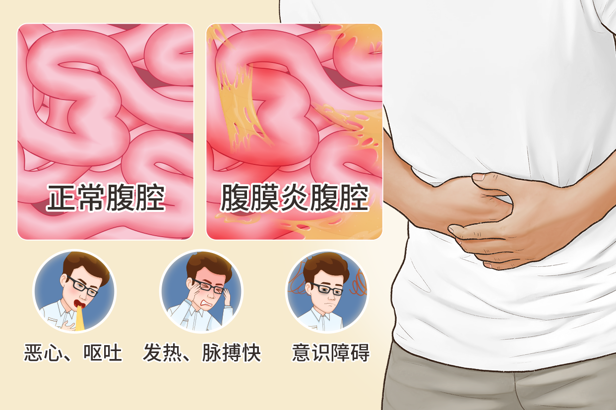 腹膜炎图片 人体腹膜炎图片