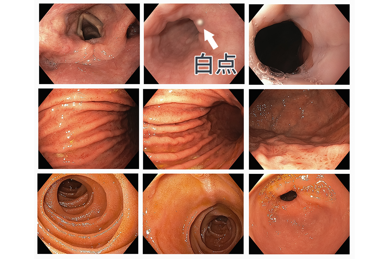 肠镜报告有白点图片