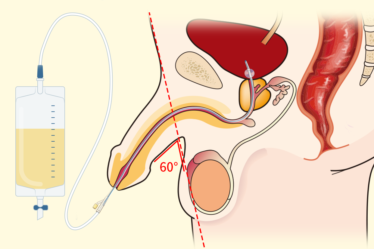 男性导尿什么时候与腹壁60度图片